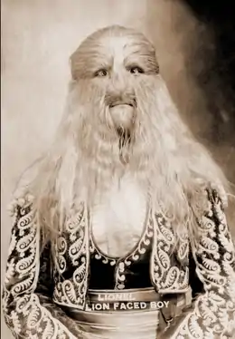 Stephan Bibrowski ou Lionel, l'homme à la tête de lion (1890–Estimation 1932).