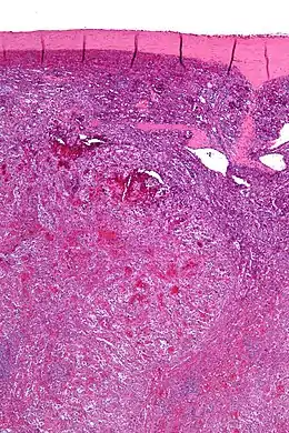 Description de l'image Littoral cell angioma of the spleen - low mag.jpg.