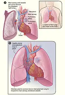 Description de l'image Lung_transplant.jpg.