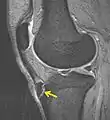 IRM d'un Osgood-Schlatter