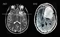 Scanner IRM d'un patient atteint d'un astrocytome montrant l'évolution sur 7 ans.