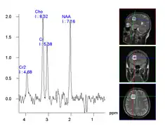 Images en spectroscopie RMN du crane d'un patient traité avec un couteau gamma.