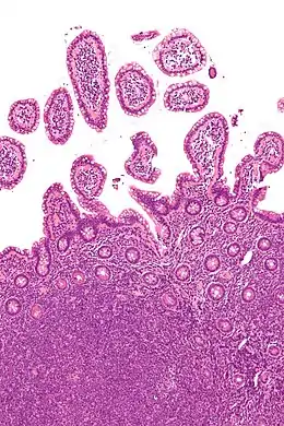 Description de l'image Mantle cell lymphoma - intermed mag.jpg.