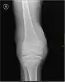 Radiographie montrant un début d'hémarthrose.