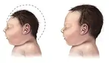  dessin montrant le profil de la tête de 2 nouveau-nés l'un ayant un petit crâne microcéphale et l'autre normal