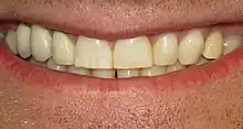 Gros plan d'une bouche souriante dont les dents présentent de petites stries blanches sur une dent.