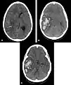 Scanner cérébral objectivant une hémorragie lobaire temporale droite évocatrice d'une possible angiopathie amyloïde