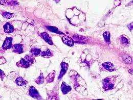 Description de l'image Myxoid liposarcoma (06).JPG.