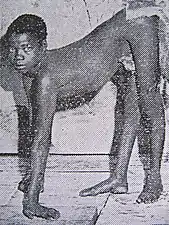 Ndola, enfant prétendument découvert parmi des singes (Afrique du Sud, 1935) : en fait il avait souffert d'une myélite paralysante.