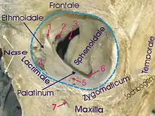 Orbite gauche. La fissure orbitaire supérieure est en 3