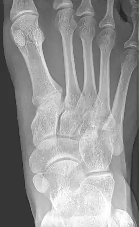 Radiographie du pied montrant un os naviculaire accessoire