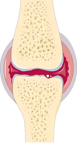 Description de l'image Osteoarthritis and rheumatoid arthritis - Rheumatoid arthritis -- Smart-Servier.png.