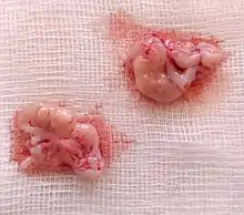 Une compresse blanche avec deux ovaires et leur tissu conjonctif associé. Les ovaires sont clairs et à leur surface sont distinguables des reliefs semblables à des bulles ; ce sont les follicules ovariens qui ont mûri.
