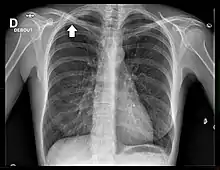 Radiographie pulmonaire de face où une tumeur difficilement visible est repérée d'une flèche.