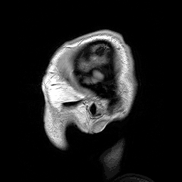 Description de l'image Parasagittal MRI of human head in patient with benign familial macrocephaly prior to brain injury (ANIMATED).gif.