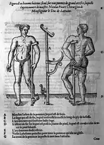 Ambroise Paré, Figure d'un homme boiteux situé sur une potence de grand artifice, 1585.