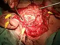 Vue opératoire montrant une dissection du nerf facial après exérèse de la parotide superficielle
