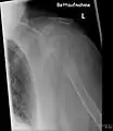 Fracture pathologique du bras gauche sur une métastase osseuse de cancer du sein