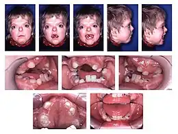 Description de l'image Patient with Apert syndrome.jpg.