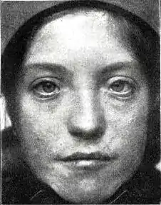 Description de l'image Patient with Waardenburg-Klein syndrome (1916).jpg.