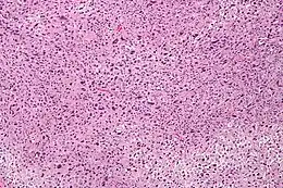 Description de l'image Pleomorphic undifferentiated sarcoma - intermed mag.jpg.