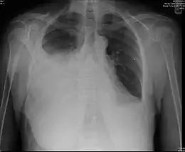 Description de l'image Pleural effusion-Metastatic breast carcinoma Case 166 (5477628658).jpg.