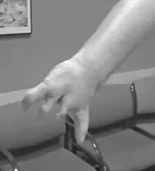 Symbrachydactylie de la main droite, caractéristique du syndrome de Poland.