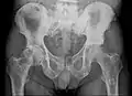 Radio du bassin d'un patient atteint d'un carcinome de la prostate : multiples métastases ostéocondensantes, en particulier sur le sacrum, mais aussi sur l'ilion surtout gauche (à dr. sur l'image), sur la pointe de l'ischion gauche, et sur le fémur proximal gauche. On détecte à l'occasion  une arthrose de hanche droite (à g. sur l'image).