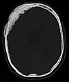 Scanner d'une métastase ostéocondensante dans l'os du crâne d'un patient souffrant d'un carcinome de la prostate. On reconnaît clairement l'extension de la métastase au-delà des limites initiales de l’os.