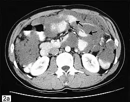 Description de l'image Pseudomyxoma.jpg.