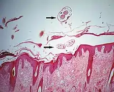 Section de la peau de l’hôte infestée d’acariens psoroptes se nourrissant en position superficielle, au-dessus de l’épiderme.