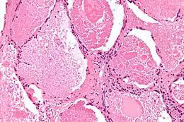 Description de l'image Pulmonary alveolar proteinosis -3- high mag.jpg.