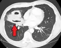 Abcès pulmonaire à la tomodensitométrie