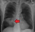 Abcès pulmonaire sur CXR