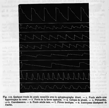 Fig. 112. Quelques tracés du pouls recueillis avec le sphygmographe direct de Marey. - 1. Pouls sénile avec hypertrophie du cœur. - 2. Pouls de la fièvre typhoïde. - 3. Colique de plomb. - 4. Péricardite. - 5. Convalescence. - 6. Pouls sénile rare. - 7. Fièvre hectique. - 8. Anévrysme disséquant de l'aorte.