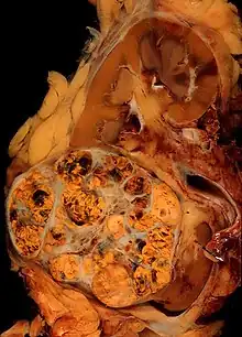 Carcinome rénal à cellules claires de 8 cm de diamètre, du pôle inférieur d'un rein, montrant une prolongation au-delà de la surface corticale, mais sans infiltration du tissu adipeux périrénal.