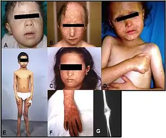 Description de l'image Rothmund-Thomson syndrome.jpg.