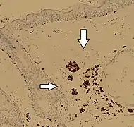 Immunohistochimie SOX10 dans un nævus dermique, montrant des cellules de nævus à coloration positive (flèches)