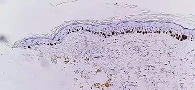 L'immunohistochimie SOX10 facilite la mise en évidence du lentigo maligna, sous la forme d'un nombre accru de mélanocytes le long de la strate basale et du pleumorphisme nucléaire. Les changements sont continus avec la marge de résection (encrée en jaune, à gauche), conférant un diagnostic de lentigo maligna non radicalement enlevé.