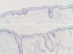 Immunohistochimie SOX10 de la peau normale (en haut) et de la prolifération mélanocytaire atypique (en bas), observée principalement dans les follicules pileux.