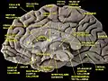 Vue médiale d'une dissection profonde montrant la face médiale de l'hémisphère cérébral.