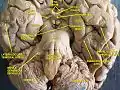 Cerveau. Vue inférieure. Dissection profonde.