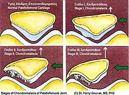 Description de l'image Stages of chindromalacia of patellofemoral joint.jpg.