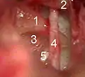 Visualisation des repères chirurgicaux (1 : branche descendante de l'enclume, 2 : membrane tympanique relevée, 3 : platine, 4 : corde du tympan, 5 : nerf facial)