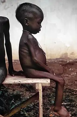 Fillette souffrant du kwashiorkor au Nigeria.