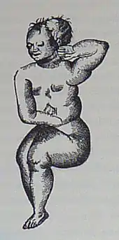 L'enfant de pierre ou « Lithopédion de Sens » par Ambroise Paré.