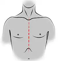 Dessin représentant un thorax et un cou, vus de face, avec le tracé de la cicatrice de sternotomie médiane.