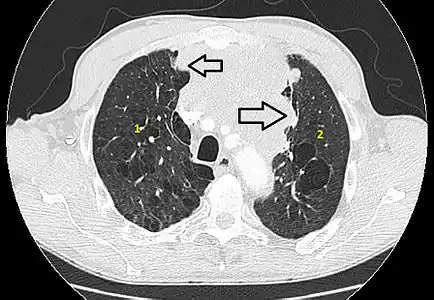 Coupe tomodensitométrique montrant une tumeur hétréogène envahissant localement les structures voisines. Le fenêtrage parenchymateux permet de voir au mieux le contact avec les poumons.