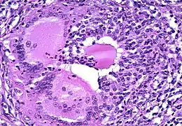 Description de l'image Thyroid colloid - Thyroiditis.jpg.