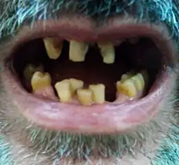 Description de l'image Tired teeth.jpg.